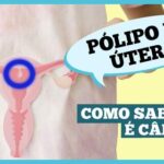 o-que-sao-polipos-uterino-e-quais-os-sintomas?