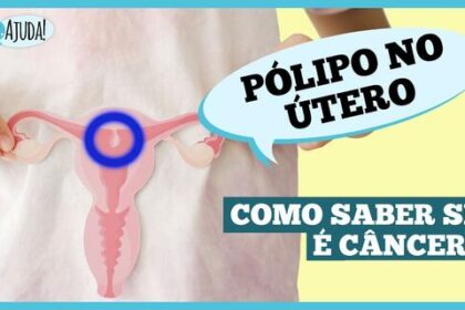 o-que-sao-polipos-uterino-e-quais-os-sintomas?