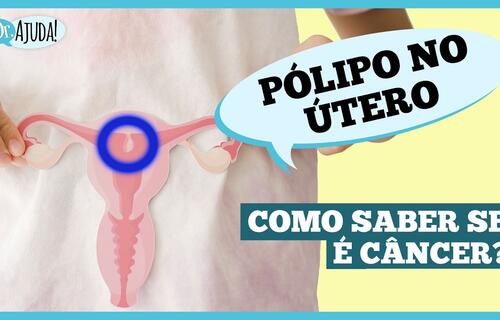 o-que-sao-polipos-uterino-e-quais-os-sintomas?
