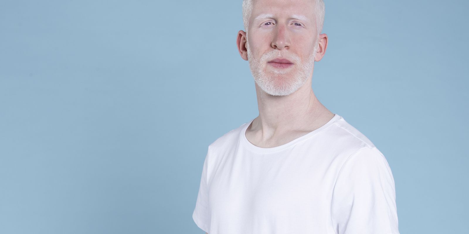 sancionada-lei-que-cria-politica-de-protecao-a-pessoas-com-albinismo