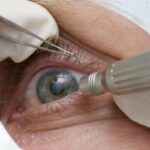 cirurgia-que-altera-cor-do-olho-tem-uso-restrito-para-pessoas-cegas
