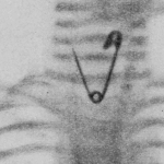 de-agulhas-a-projeteis:-a-tecnologia-que-encontra-metais-perdidos-no-corpo