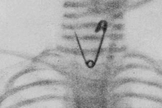 de-agulhas-a-projeteis:-a-tecnologia-que-encontra-metais-perdidos-no-corpo