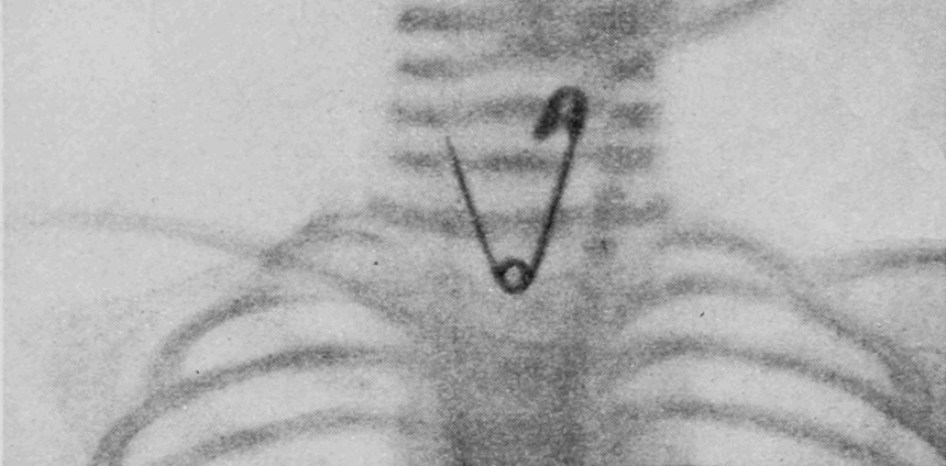 de-agulhas-a-projeteis:-a-tecnologia-que-encontra-metais-perdidos-no-corpo