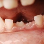 por-que-as-pessoas-tem-dentes-de-leite-e-dentes-permanentes?