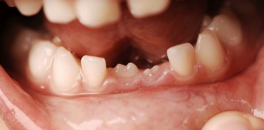 por-que-as-pessoas-tem-dentes-de-leite-e-dentes-permanentes?