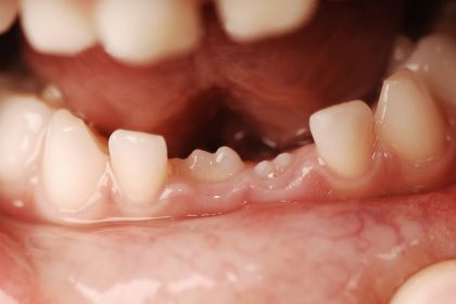 por-que-as-pessoas-tem-dentes-de-leite-e-dentes-permanentes?