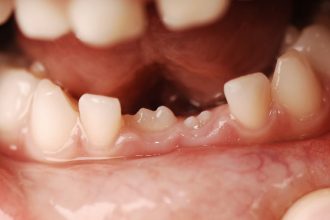 por-que-as-pessoas-tem-dentes-de-leite-e-dentes-permanentes?