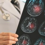 como-as-celulas-tronco-podem-ajudar-na-recuperacao-do-cerebro-apos-um-derrame