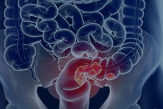 pacientes-com-cancer-colorretal-sao-diagnosticados-em-estagio-avancado