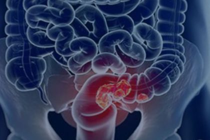 pacientes-com-cancer-colorretal-sao-diagnosticados-em-estagio-avancado
