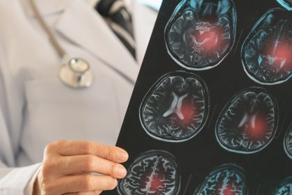 como-as-celulas-tronco-podem-ajudar-na-recuperacao-do-cerebro-apos-um-derrame