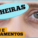 olheiras:-por-que-aparecem-e-o-que-fazer